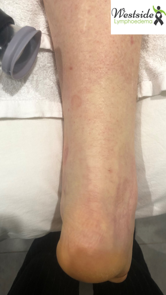 Lower leg with lymphedema around the ankle before LymphaTouch treatment