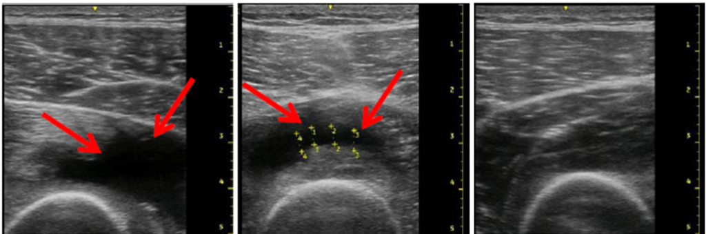 Ultrasound images of the vastus intermedius contusion on days 1, 4 and 8 after the injury