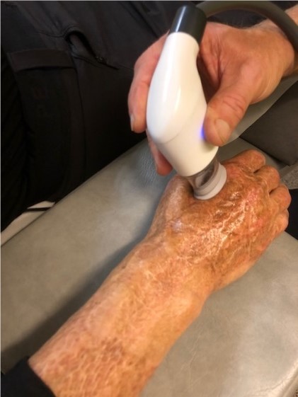 Scarring from burns and skin grafts on the back of the hand