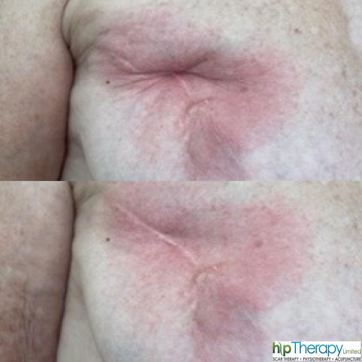 Lumpectomy scar before and after the treatment period