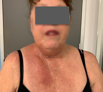Patient's neck and upper chest before the intervention, photo 2
