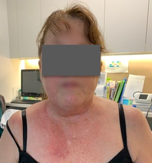 Patient's neck and upper chest after the intervention, photo 2