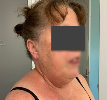 Patient's neck and upper chest before the intervention, photo 1