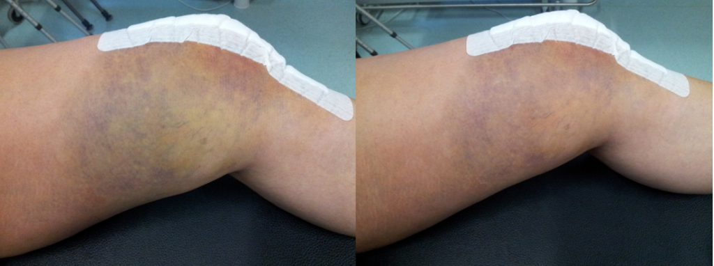 Knee after replacement surgery, before LymphaTouch treatment and after 30 minutes of treatment