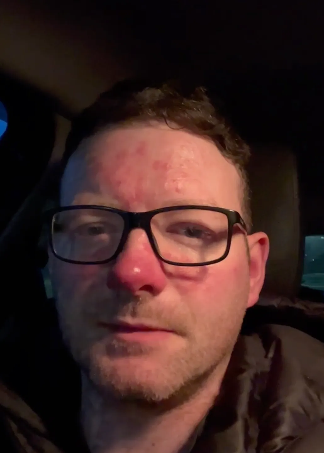 Close-up of a man with glasses and short hair, sitting in a car, with red patches and redness on his forehead and nose.