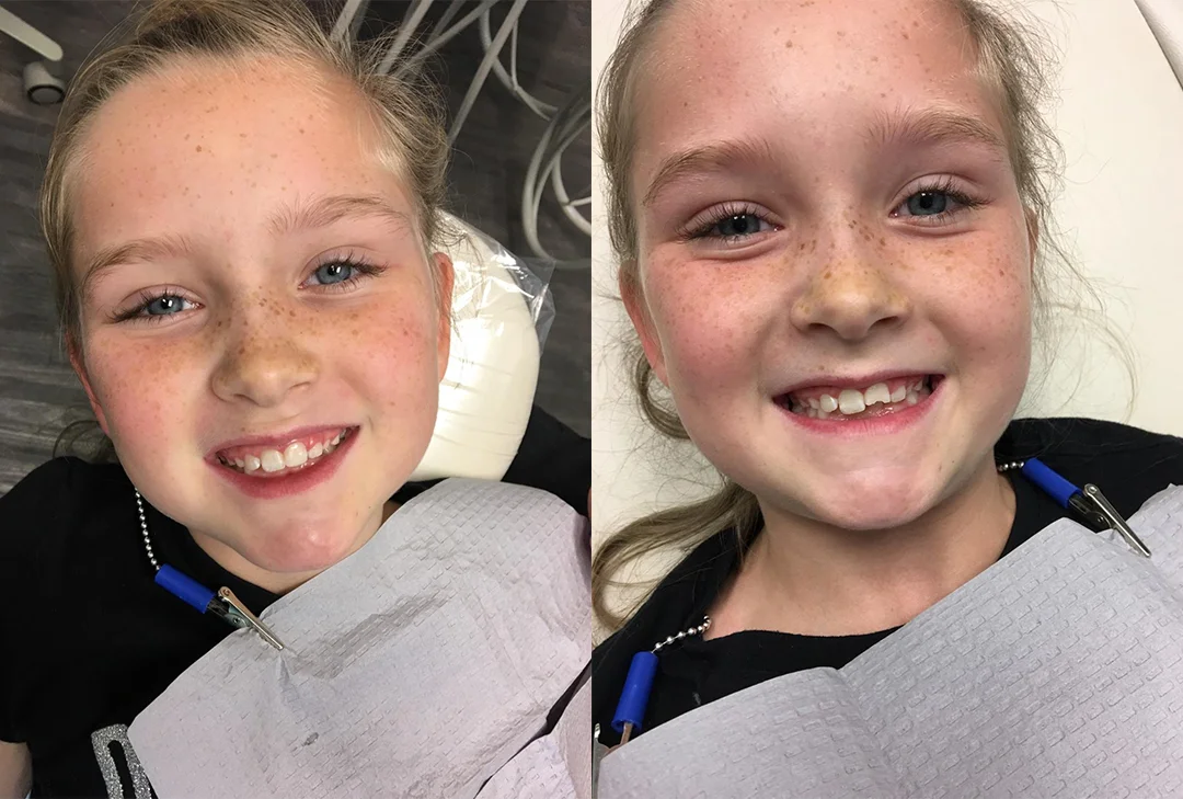 Before and after: a young patient's healthy smile