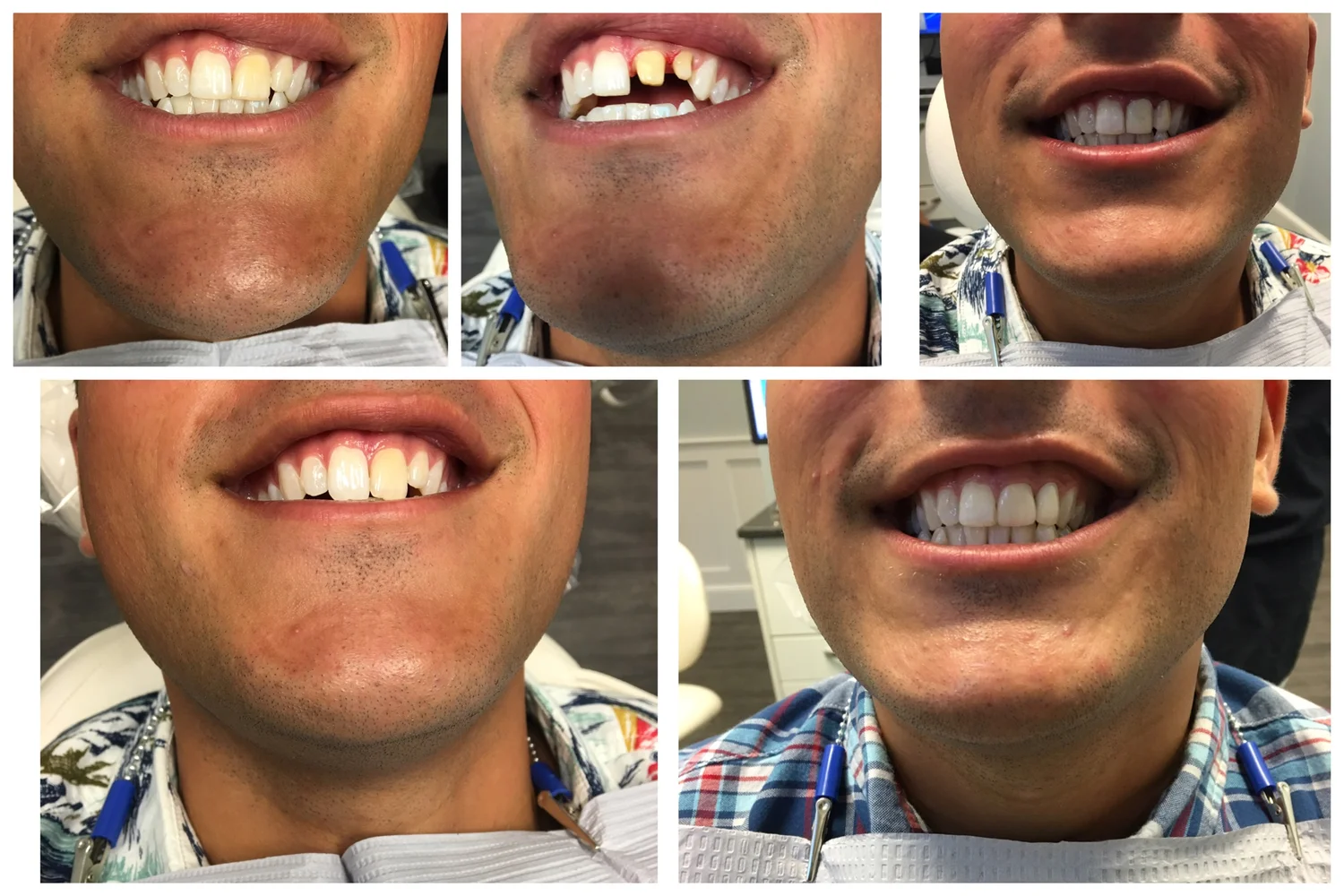 Before and after: a gap between the front teeth closed