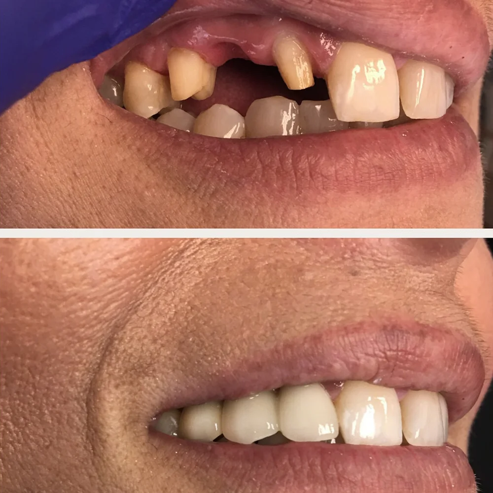 Before and after: missing front teeth replaced with a natural-looking bridge