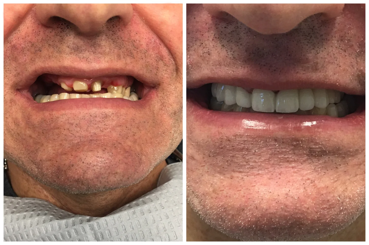 Before and after: worn and broken front teeth restored