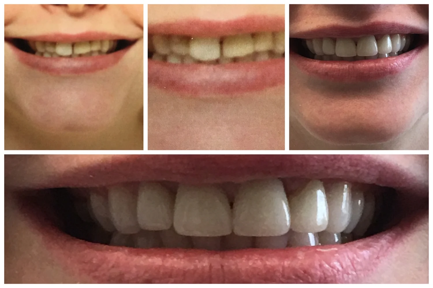 Before and after: a brighter, more even smile