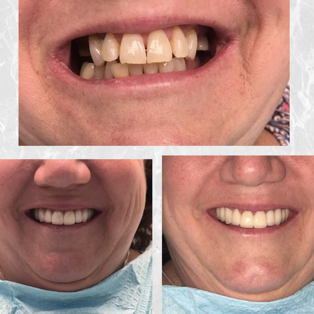 Before and after: a smile makeover