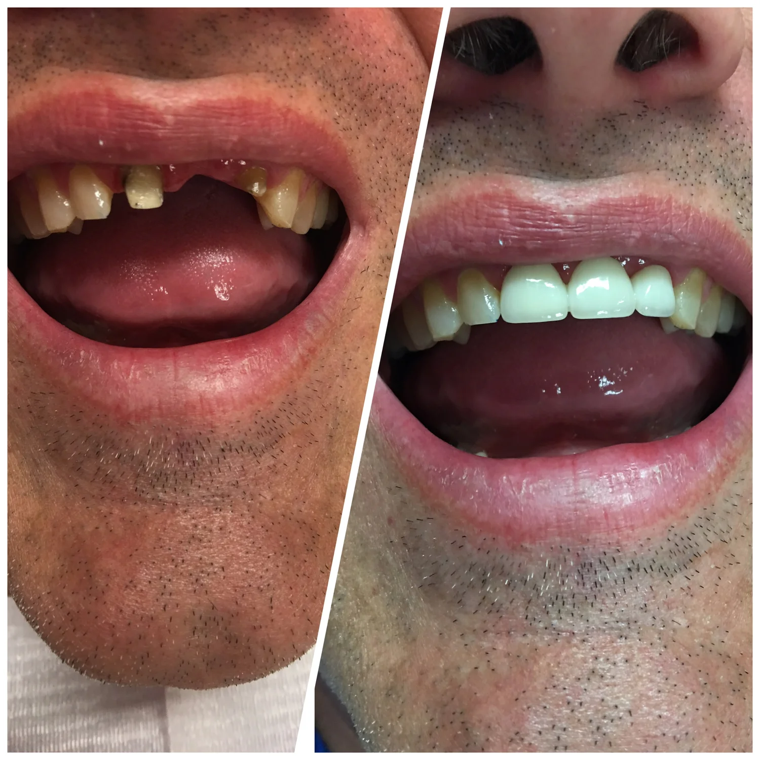 Before and after: damaged teeth rebuilt