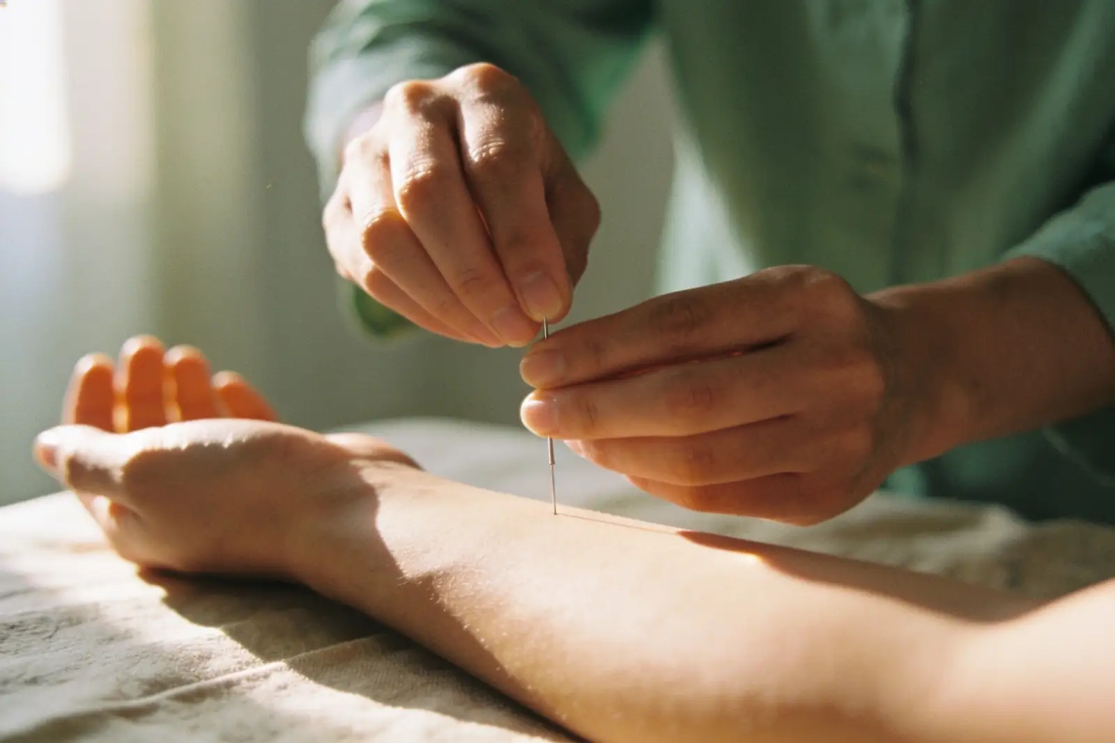 Acupuncture session in progress with fine needles on a relaxed patient