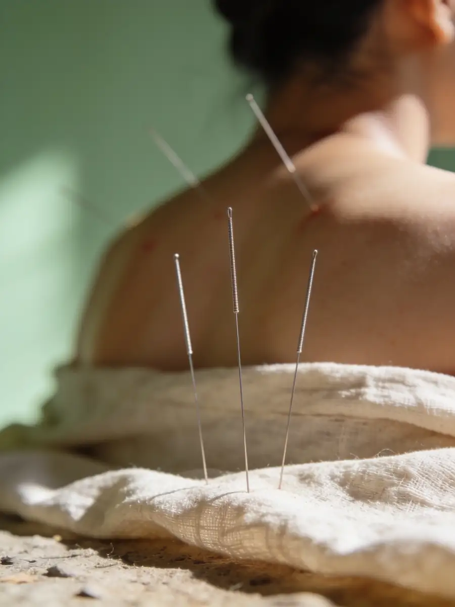 Acupuncture session