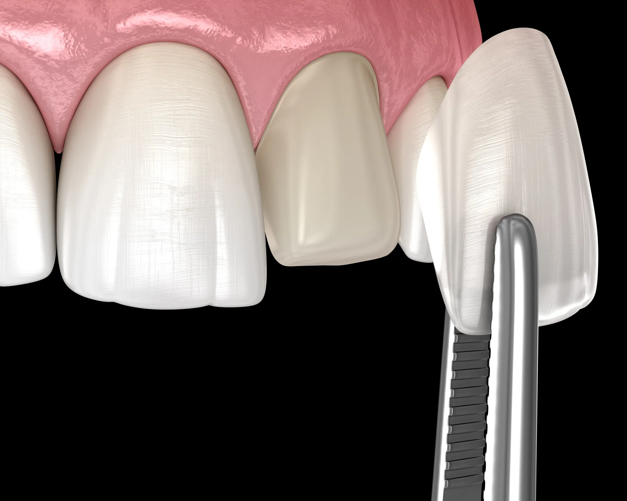 Porcelain Veneers