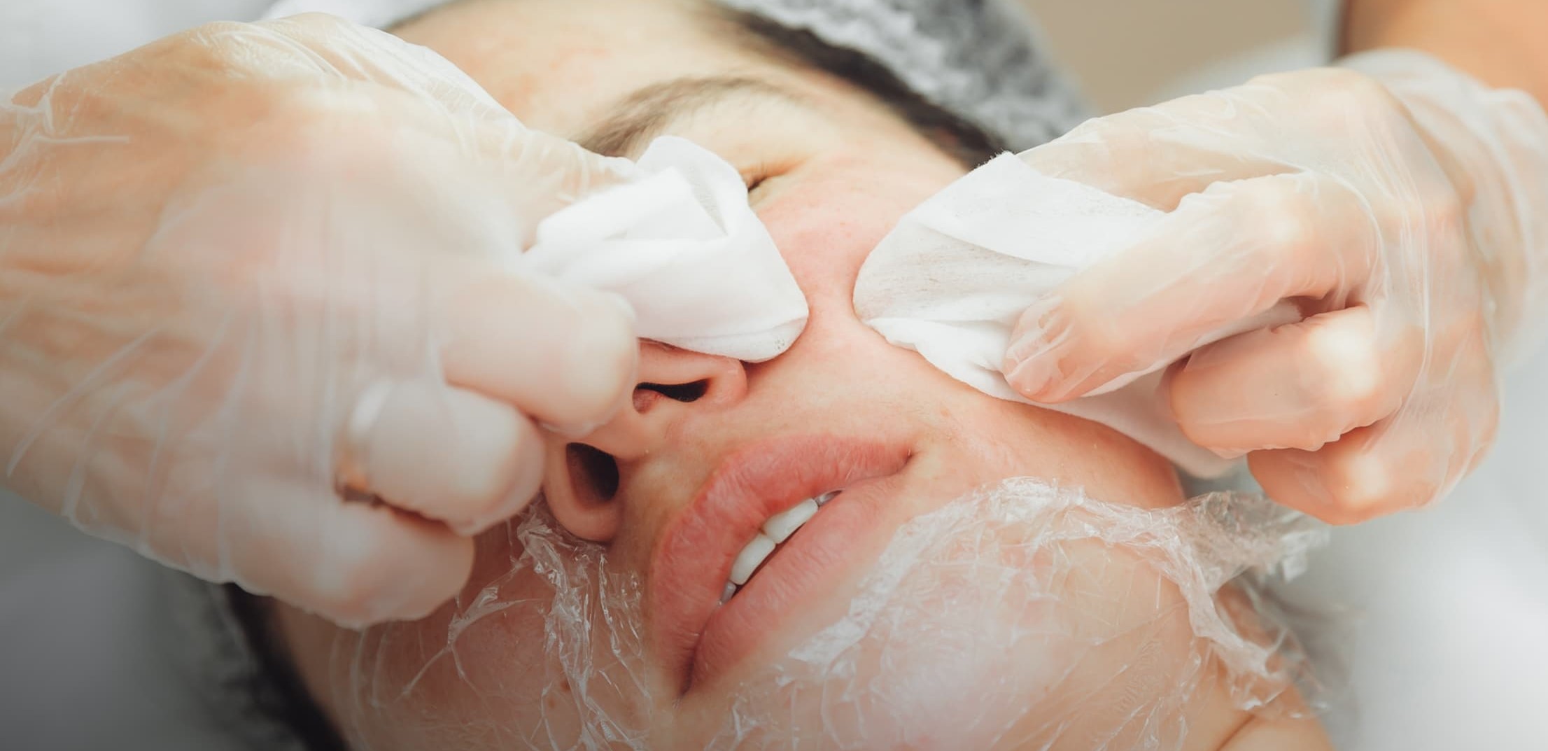 Acne clarifying facial at NewskinLA in Burbank