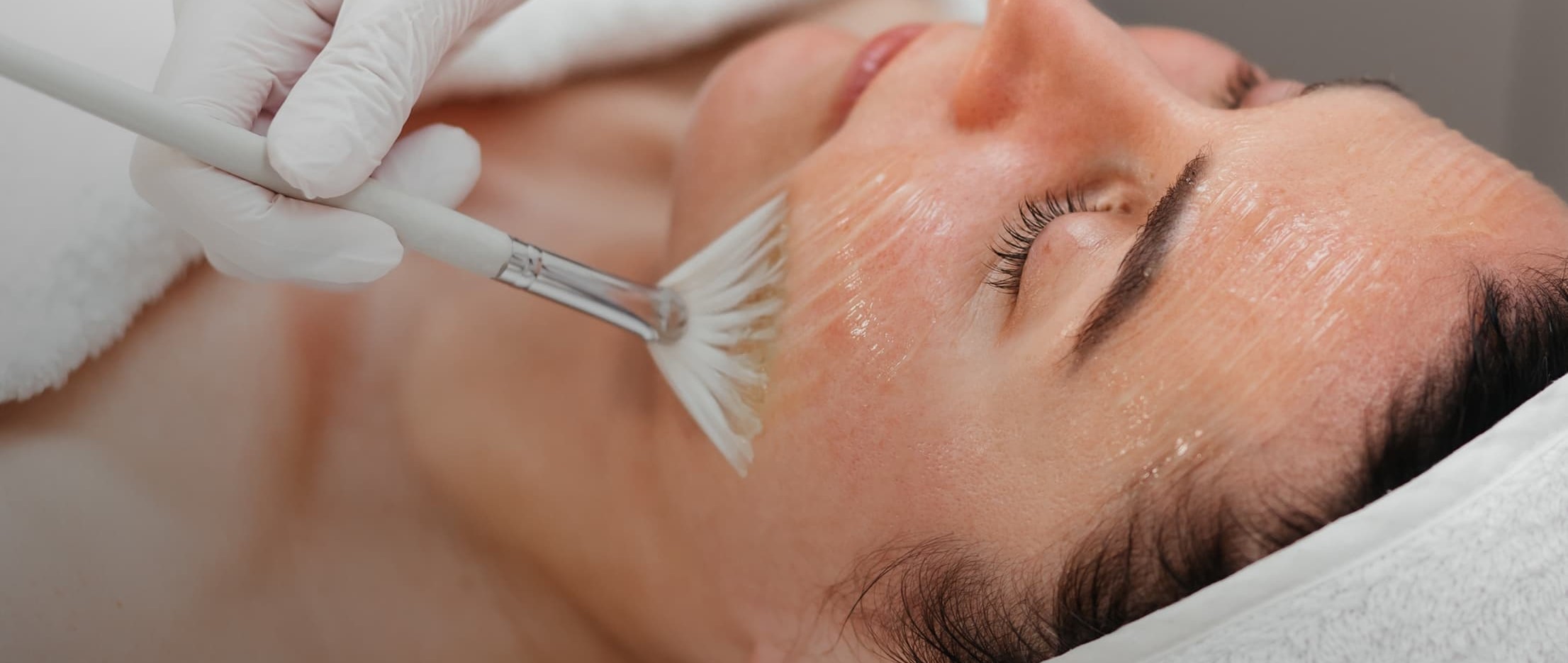 TCA peel at NewskinLA in Burbank