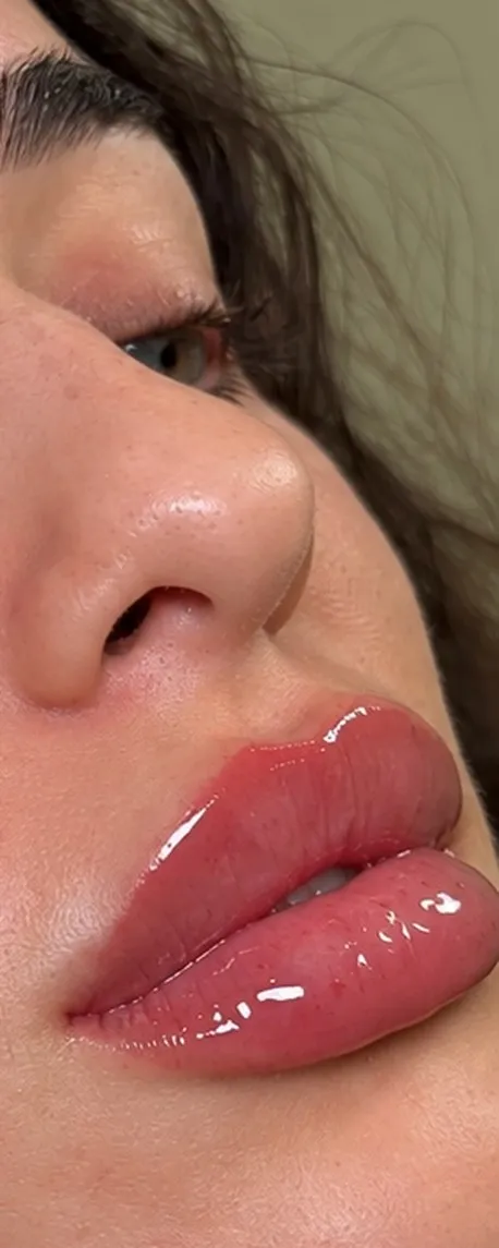 After lip filler at Cosmetica Med Spa, fuller lips in side profile