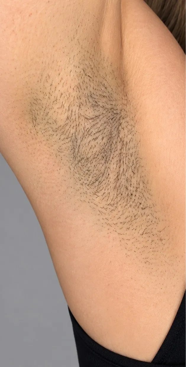 Before laser hair removal at Cosmetica Med Spa, underarm with dark hair