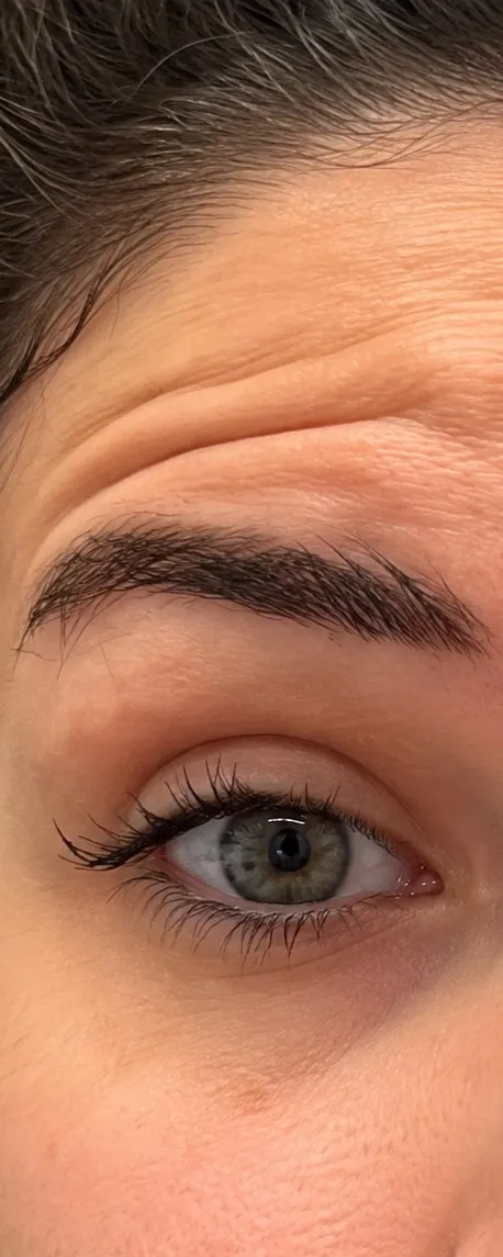 Before Botox at Cosmetica Med Spa, forehead lines when raising brows
