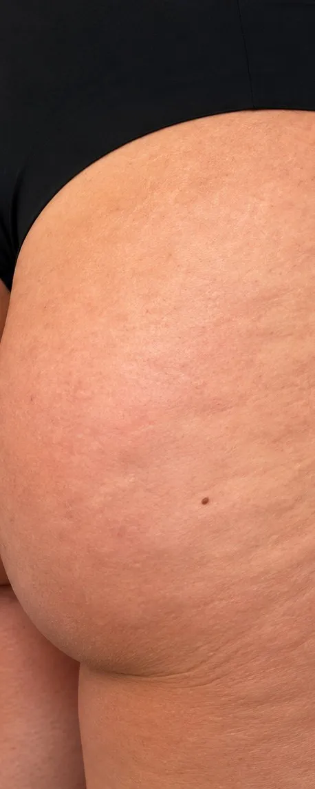 Before non-surgical BBL at Cosmetica Med Spa, buttocks and upper thigh