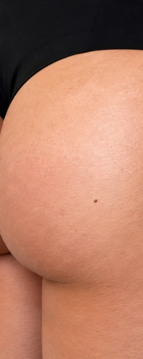 After non-surgical BBL at Cosmetica Med Spa, lifted and smoother buttocks