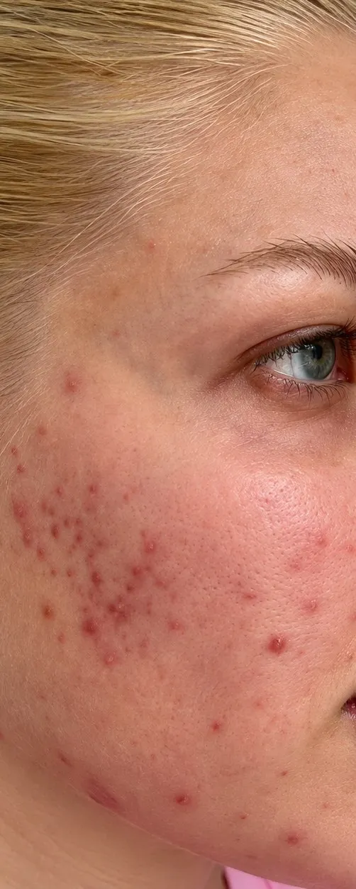Before Hydrafacial at Cosmetica Med Spa, cheek with active breakouts and redness