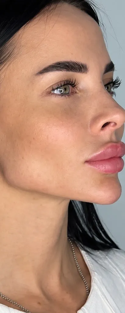 After jawline filler at Cosmetica Med Spa, side profile