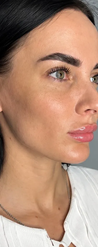 Before jawline filler at Cosmetica Med Spa, side profile