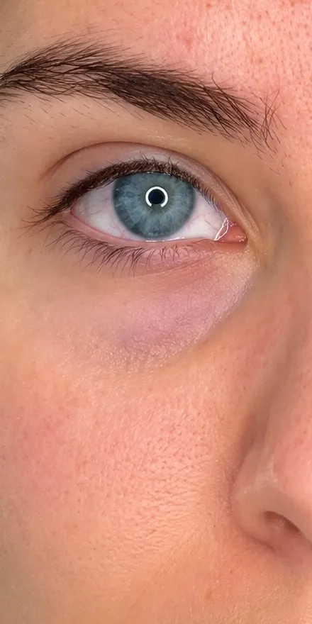 Before under-eye filler at Cosmetica Med Spa, hollow and dark under-eye area