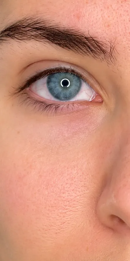 After under-eye filler at Cosmetica Med Spa, smoother and brighter under-eye area
