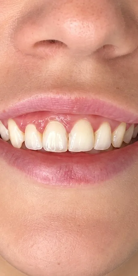 Before Botox lip flip at Cosmetica Med Spa, gums showing above the front teeth when smiling