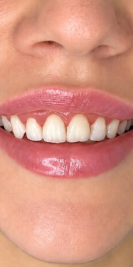 After Botox lip flip at Cosmetica Med Spa, fuller upper lip and less gum showing when smiling