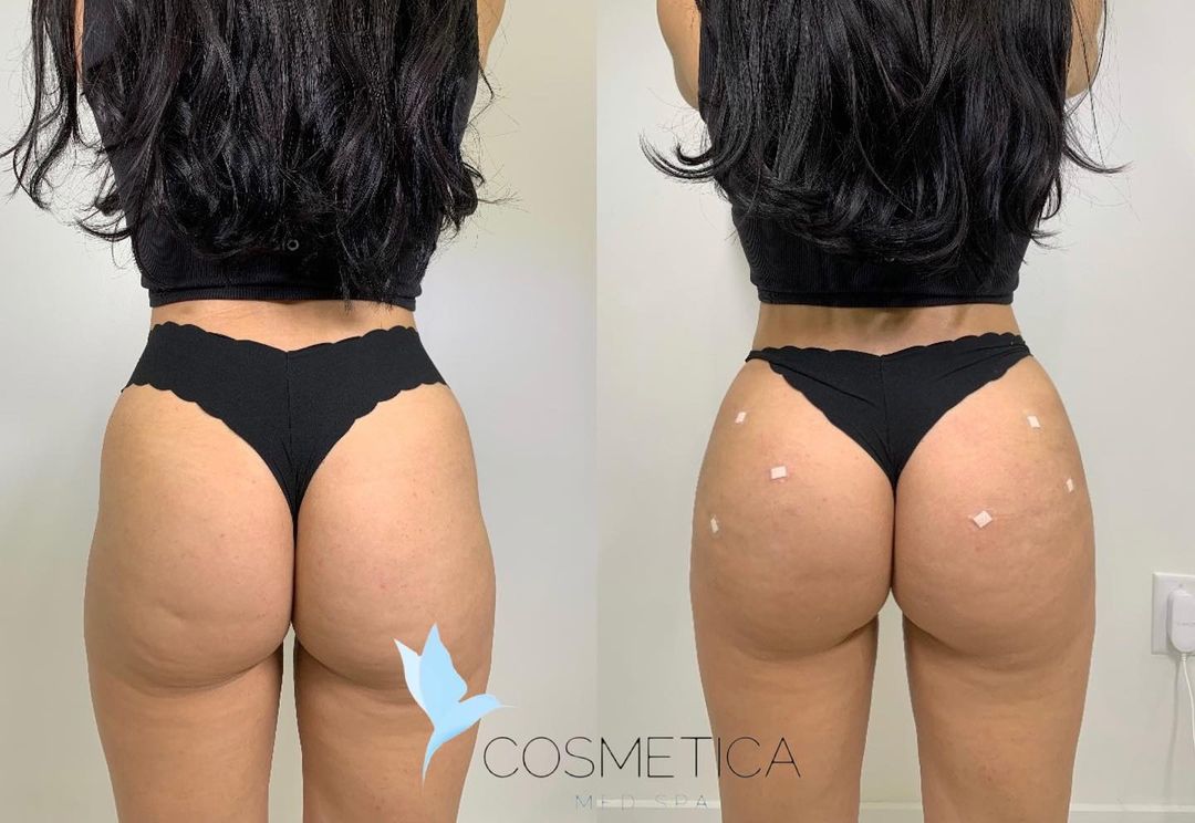Before and after non-surgical BBL at Cosmetica Med Spa in Boca Raton, back view, client 2