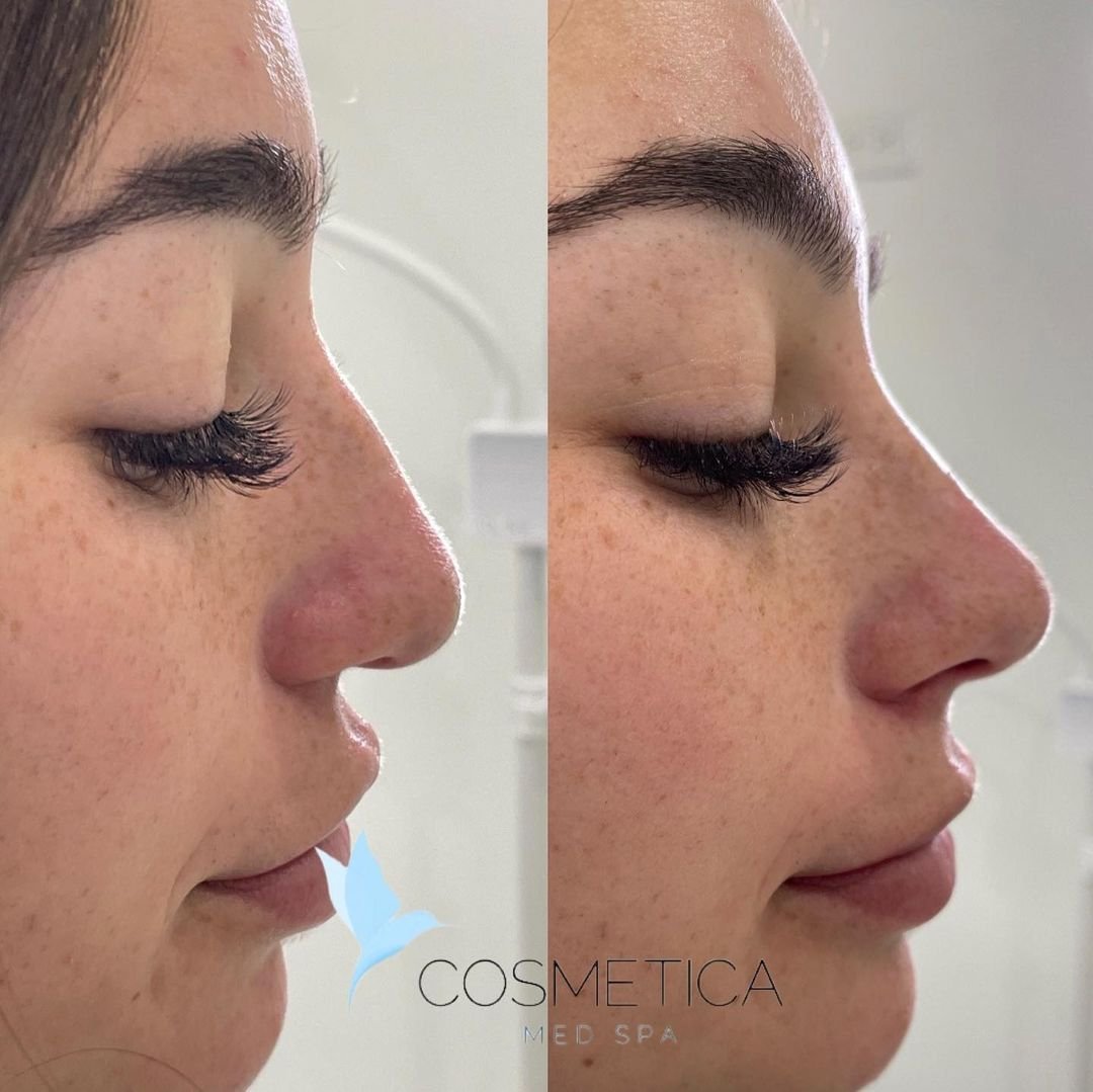Before and after non-surgical nose job with filler at Cosmetica Med Spa in Boca Raton, side profile, client 1