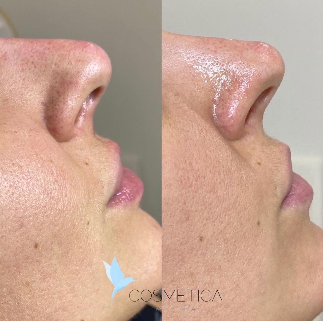 Before and after non-surgical nose job with filler at Cosmetica Med Spa in Boca Raton, side profile, client 3