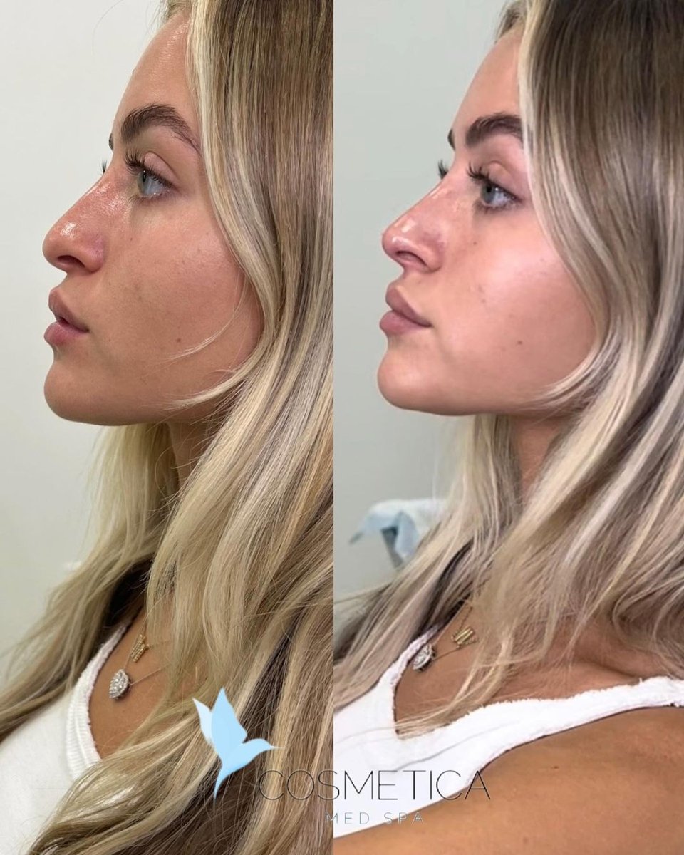 Before and after non-surgical nose job with filler at Cosmetica Med Spa in Boca Raton, side profile, client 5