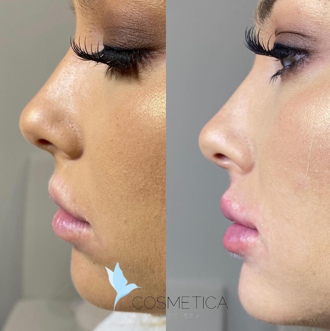 Before and after non-surgical nose job with filler at Cosmetica Med Spa in Boca Raton, side profile, client 2