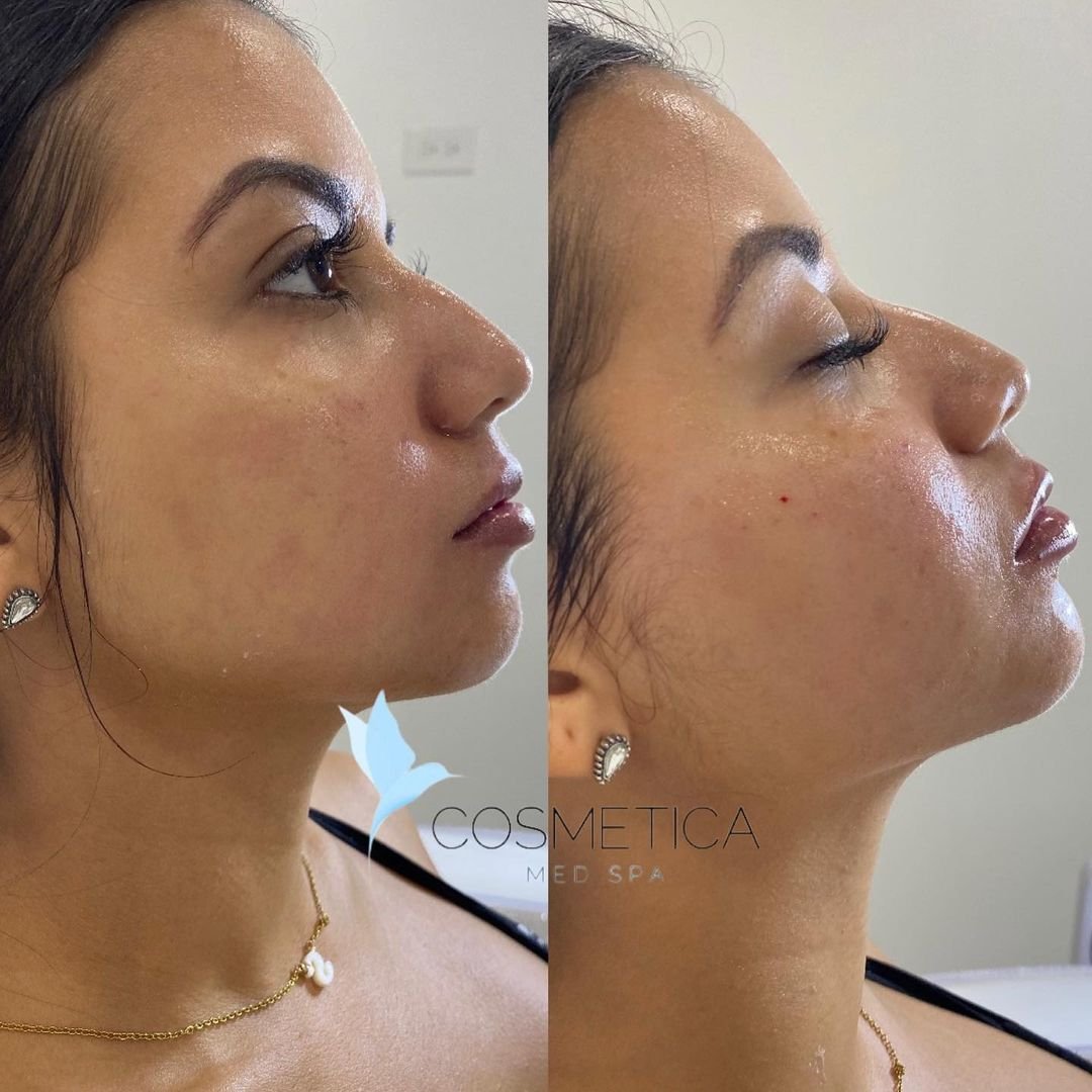 Before and after non-surgical nose job with filler at Cosmetica Med Spa in Boca Raton, side profile, client 4
