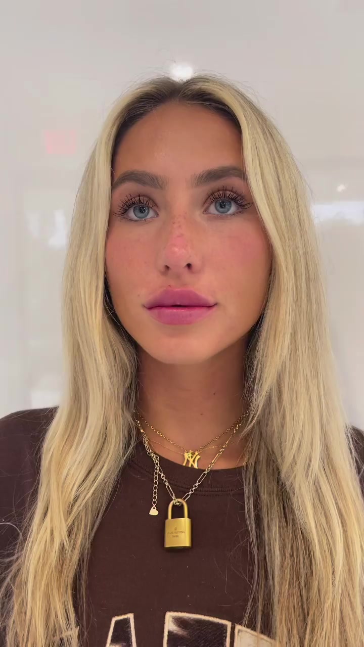 Alix Earle after her filler treatment at Cosmetica Med Spa in Boca Raton