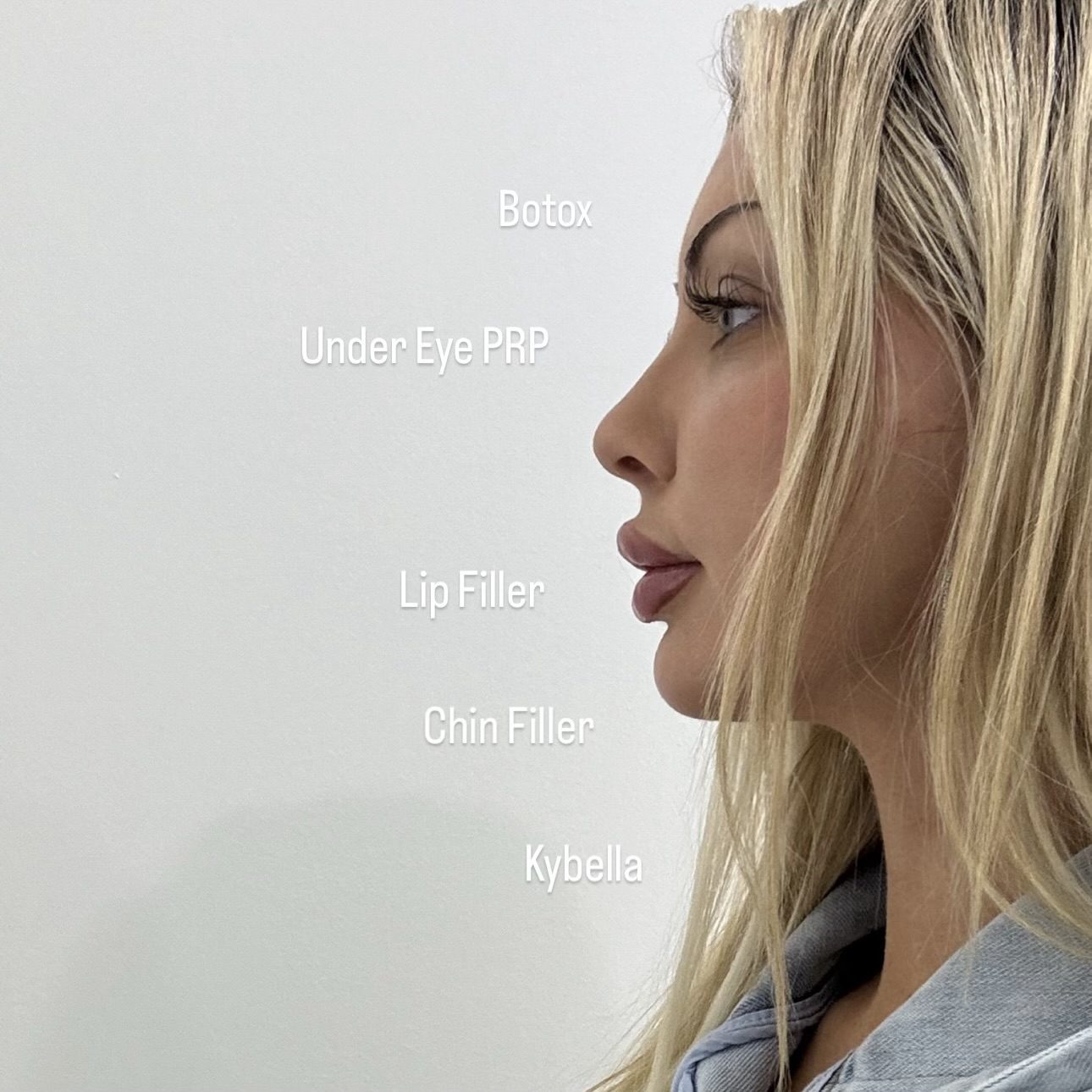 Side profile showing a combination treatment plan with Botox, under-eye PRP, lip filler, chin filler and Kybella at Cosmetica Med Spa