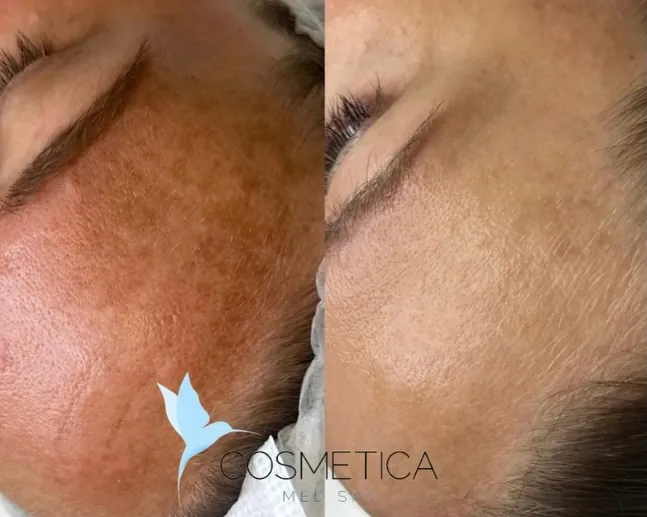 Before and after IPL photofacial at Cosmetica Med Spa in Boca Raton, sun damage and pigmentation on the forehead, client 3
