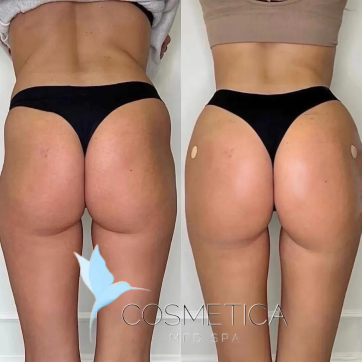 Before and after non-surgical BBL with lipo shots at Cosmetica Med Spa in Boca Raton, back view, client 4
