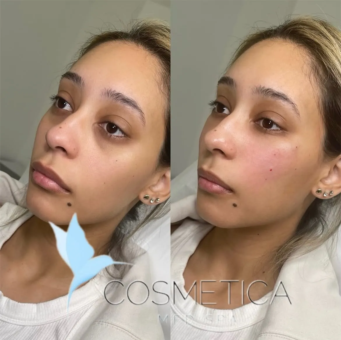 Before and after under-eye PRP and PRF at Cosmetica Med Spa in Boca Raton, client 1