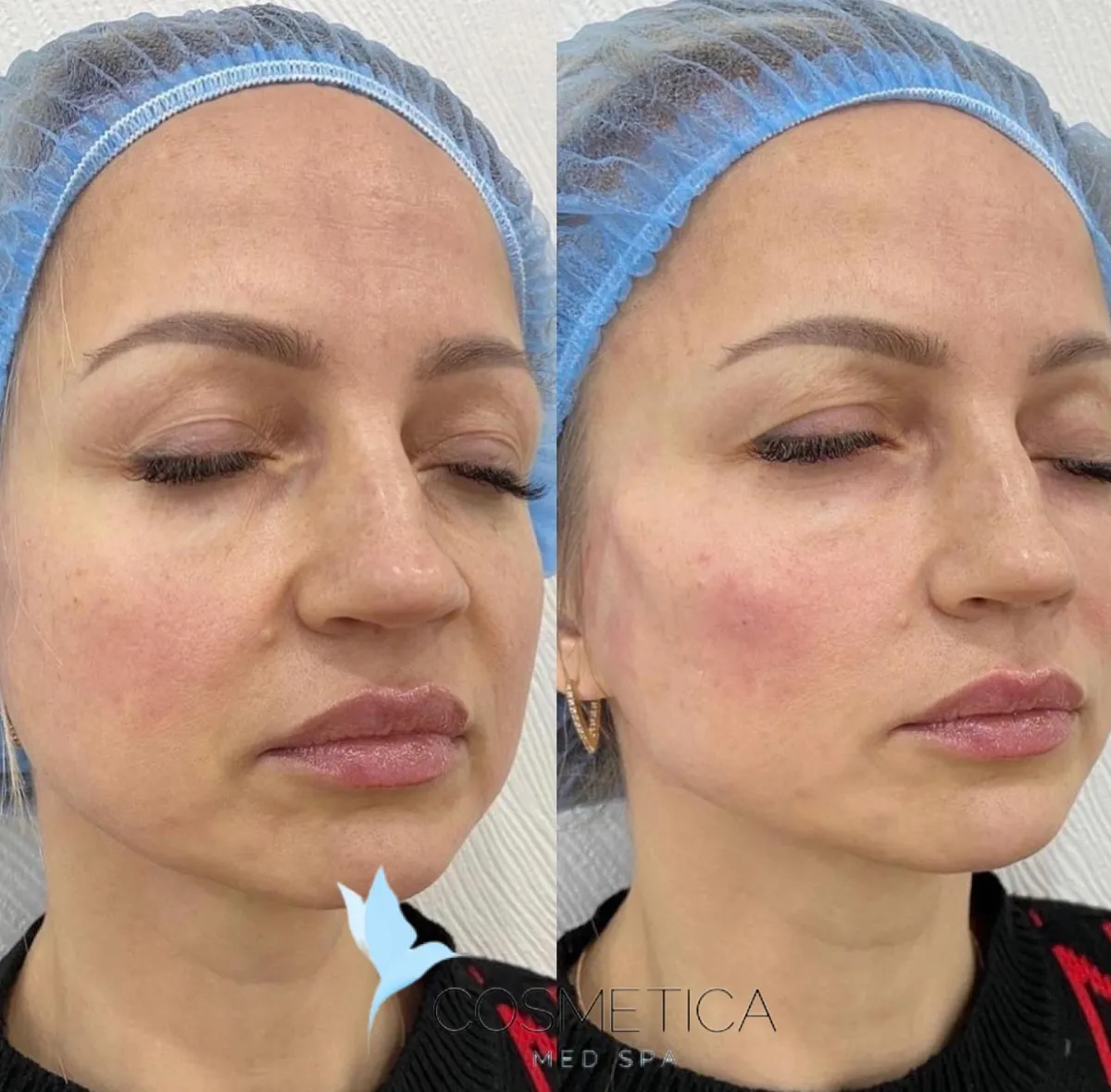 Before and after Radiesse at Cosmetica Med Spa in Boca Raton, three-quarter view, client 1