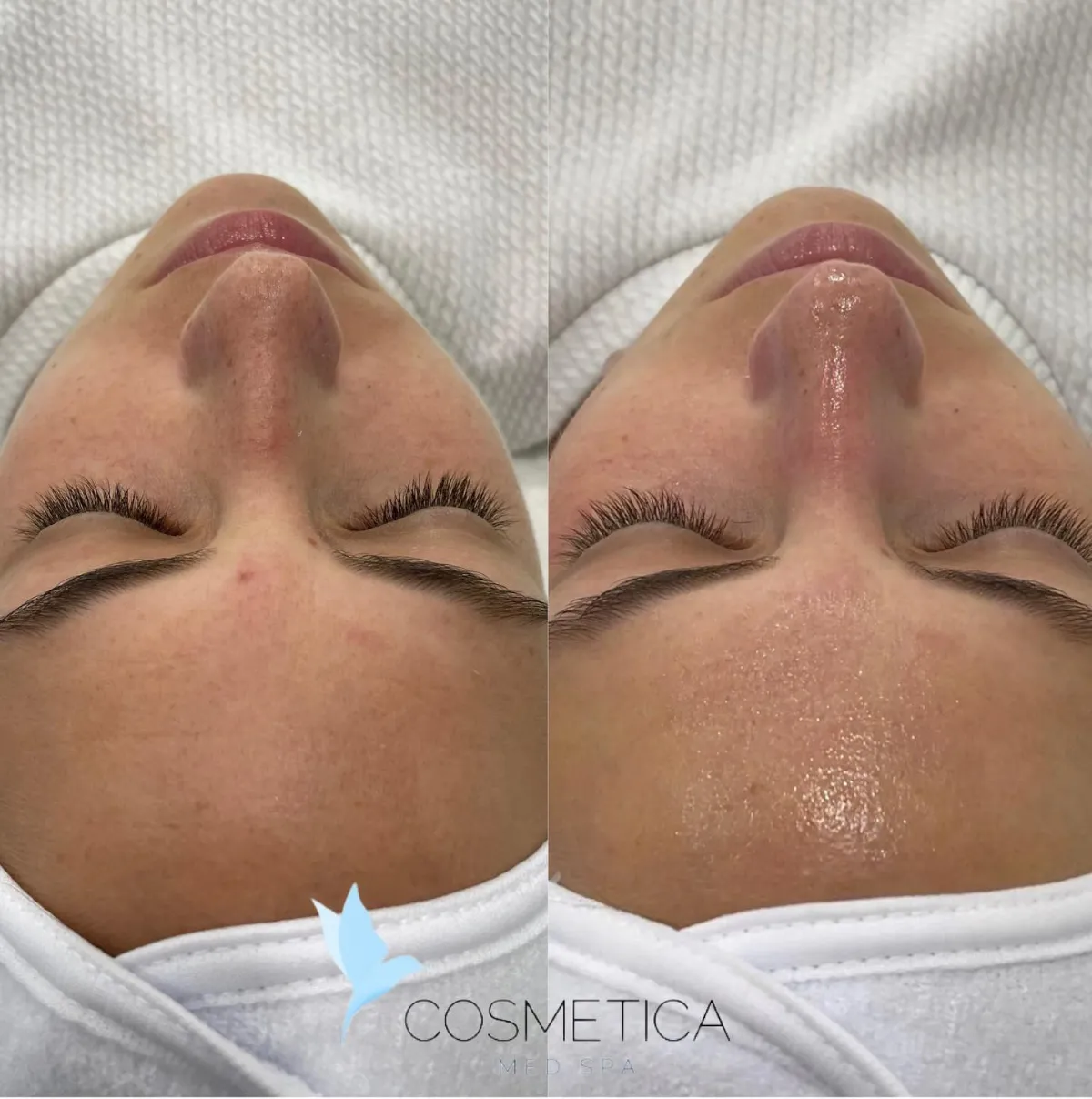 Before and after Hydrafacial at Cosmetica Med Spa in Boca Raton, view from above, client 1