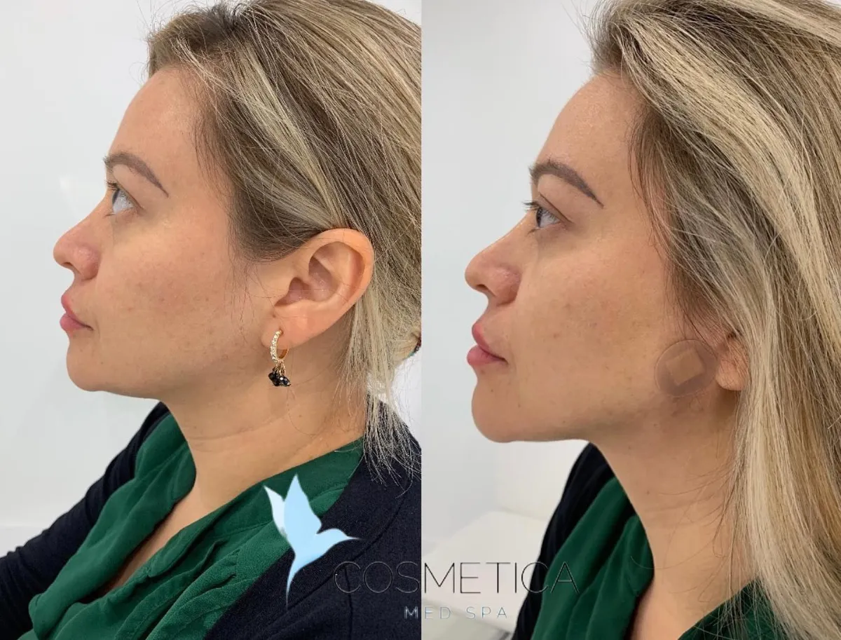Before and after PDO thread lift at Cosmetica Med Spa in Boca Raton, side profile, client 1