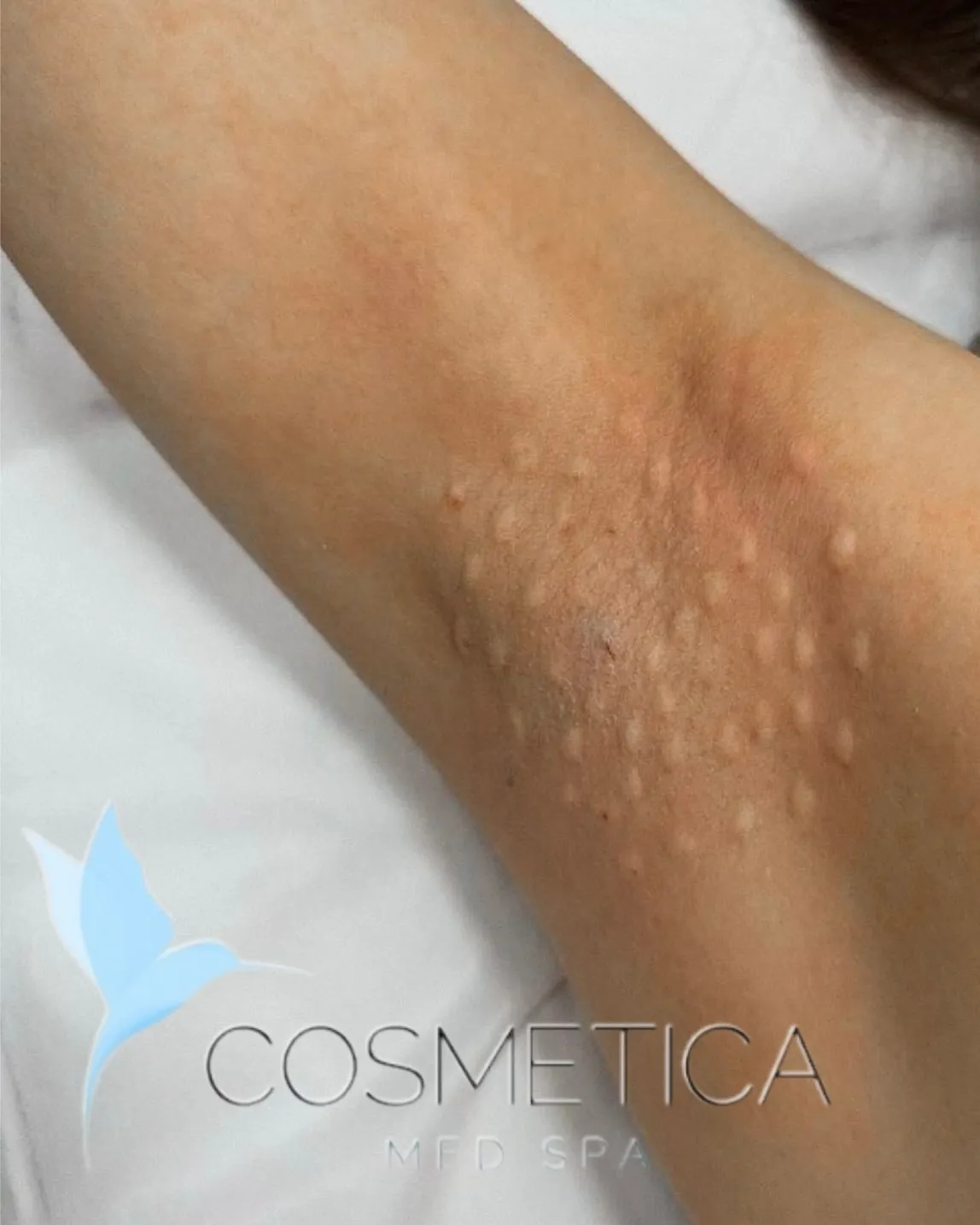 Underarm right after Botox for excessive sweating, showing the small injection bumps, at Cosmetica Med Spa in Boca Raton