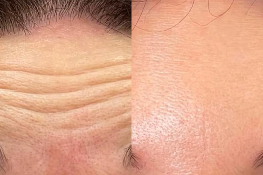 Before and after Botox at Cosmetica Med Spa in Boca Raton, close-up of the forehead, client 3