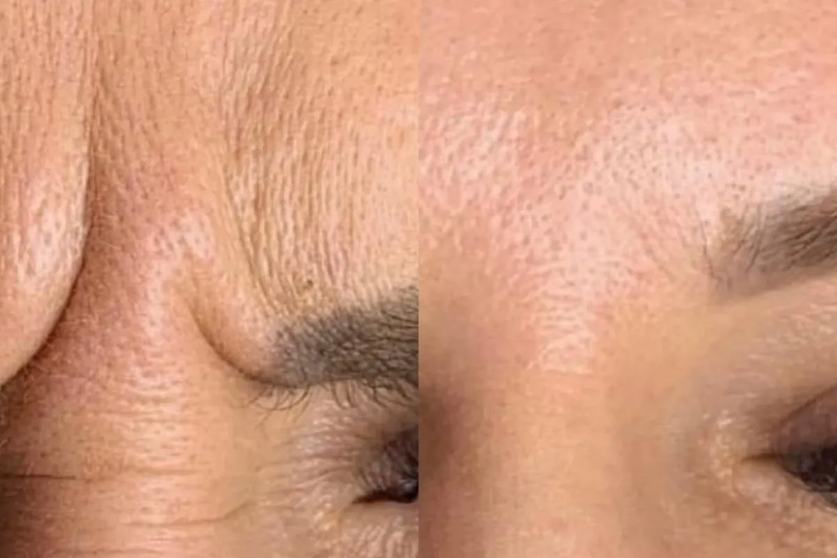 Before and after Botox at Cosmetica Med Spa in Boca Raton, close-up of the frown lines between the brows, client 7